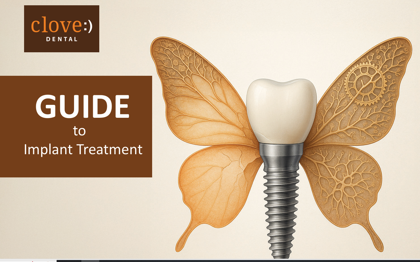 Guide to Implant Treatment 