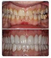 Full Mouth Rehabilitation Therapy